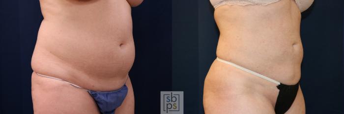 Before & After Liposuction Case 683 Right Oblique View in Torrance, CA
