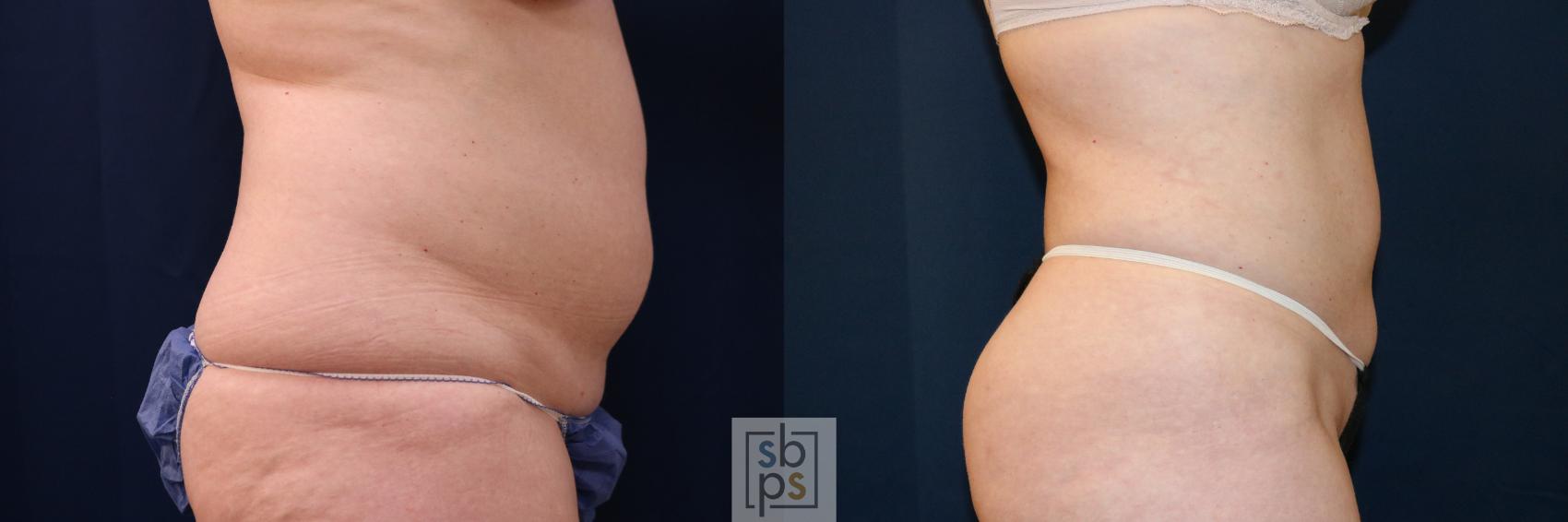 Before & After Liposuction Case 683 Right Side View in Torrance & Los Angeles, CA, CA