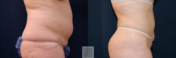 Before & After Liposuction Case 683 Right Side View in Torrance, CA