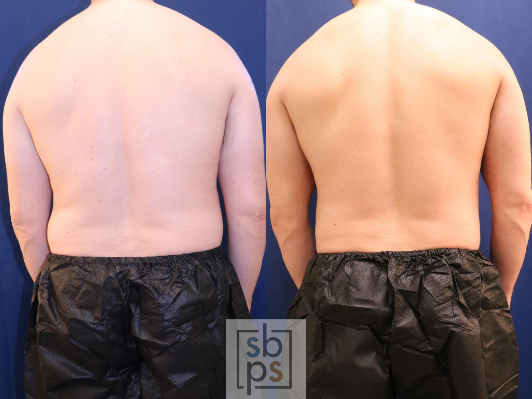 Before & After Liposuction Case 693 Back View in Torrance & Los Angeles, CA, CA