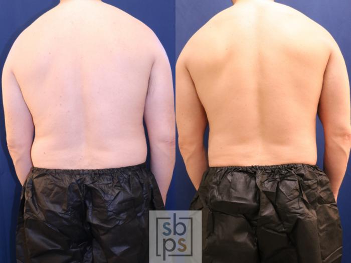 Before & After Liposuction Case 693 Back View in Los Angeles & Torrance, CA, CA