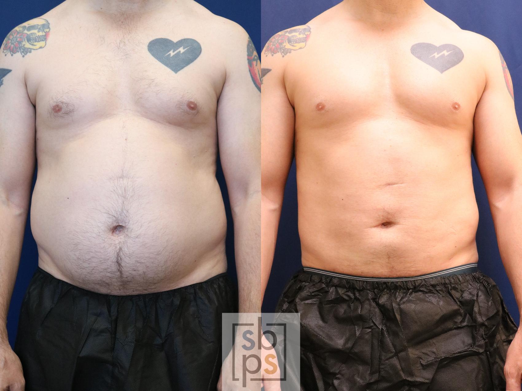 Before & After Liposuction Case 693 Front View in Los Angeles & Torrance, CA, CA