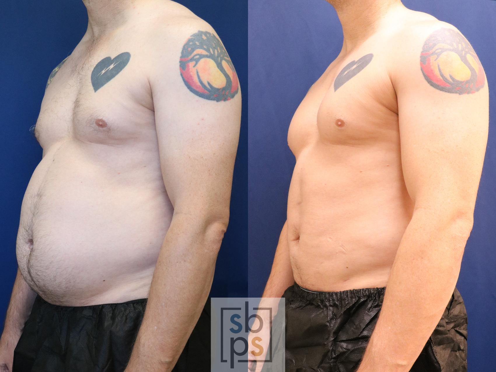 Before & After Liposuction Case 693 Left Oblique View in Torrance & Los Angeles, CA, CA