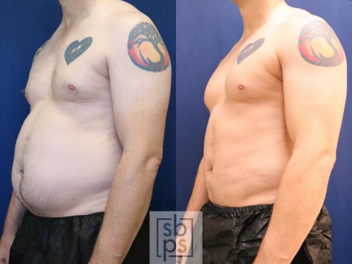 Before & After Liposuction Case 693 Left Oblique View in Los Angeles & Torrance, CA, CA