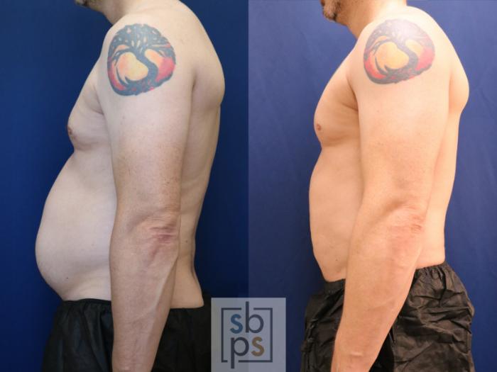 Before & After Liposuction Case 693 Left Side View in Los Angeles & Torrance, CA, CA