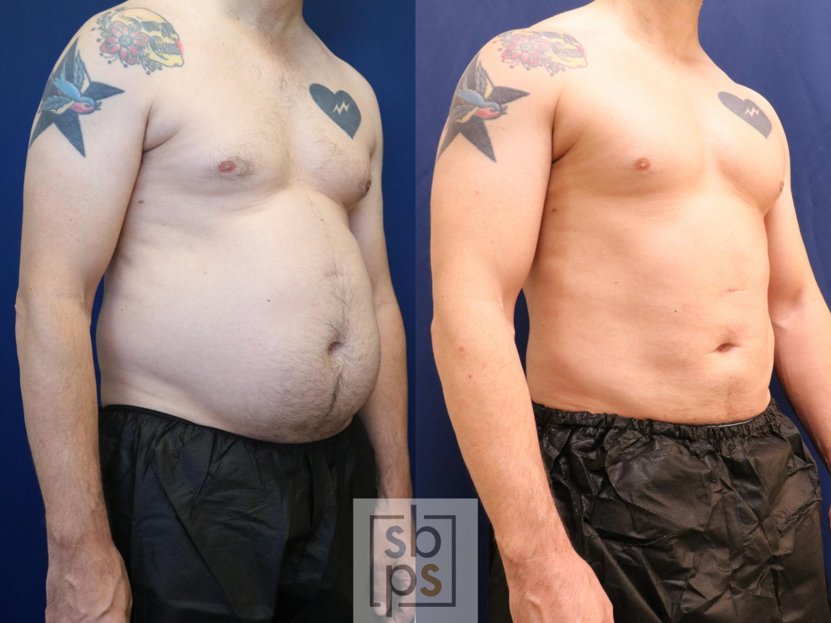 Before & After Liposuction Case 693 Right Oblique View in Torrance & Los Angeles, CA, CA