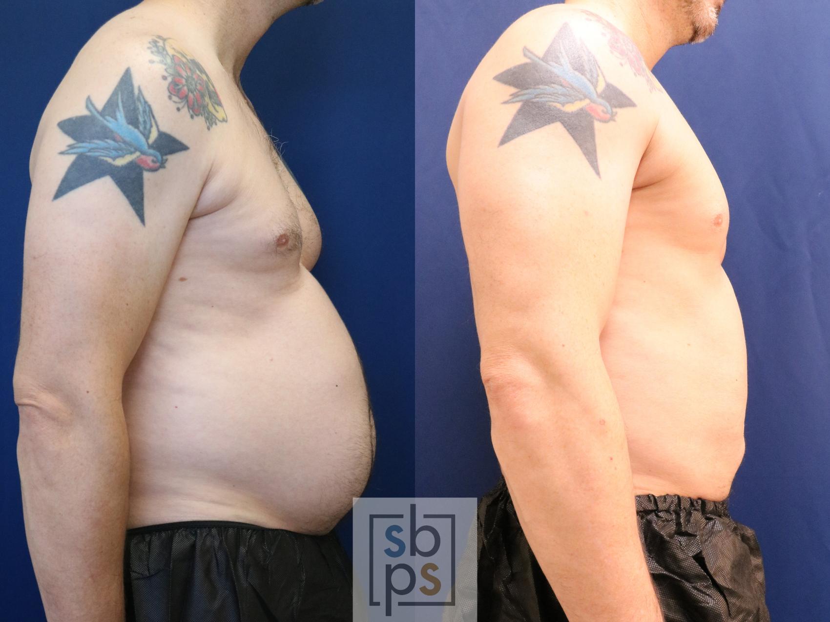 Before & After Liposuction Case 693 Right Side View in Torrance & Los Angeles, CA, CA