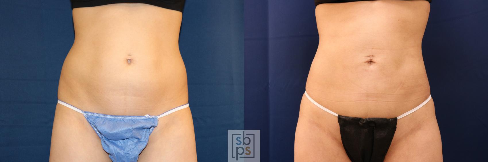 Before & After Liposuction Case 708 Front View in Los Angeles & Torrance, CA, CA