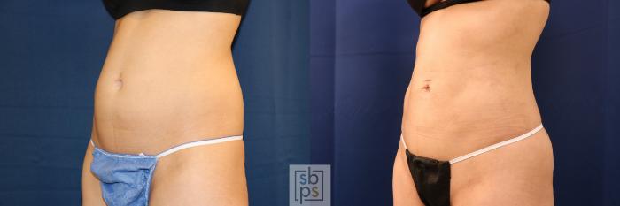 Before & After Liposuction Case 708 Left Oblique View in Los Angeles & Torrance, CA, CA