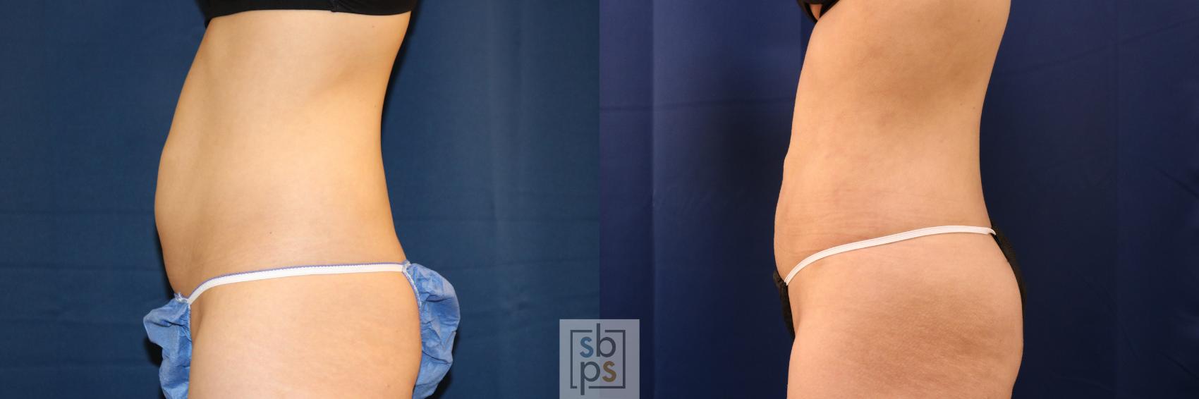 Before & After Liposuction Case 708 Left Side View in Torrance & Los Angeles, CA, CA