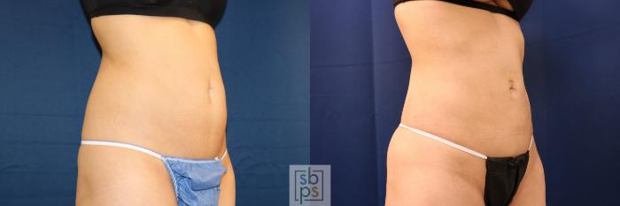 Before & After Liposuction Case 708 Right Oblique View in Los Angeles & Torrance, CA, CA