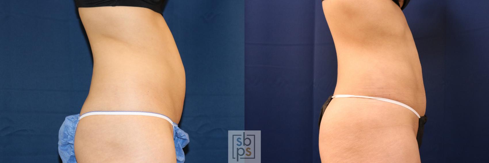 Before & After Liposuction Case 708 Right Side View in Torrance & Los Angeles, CA, CA