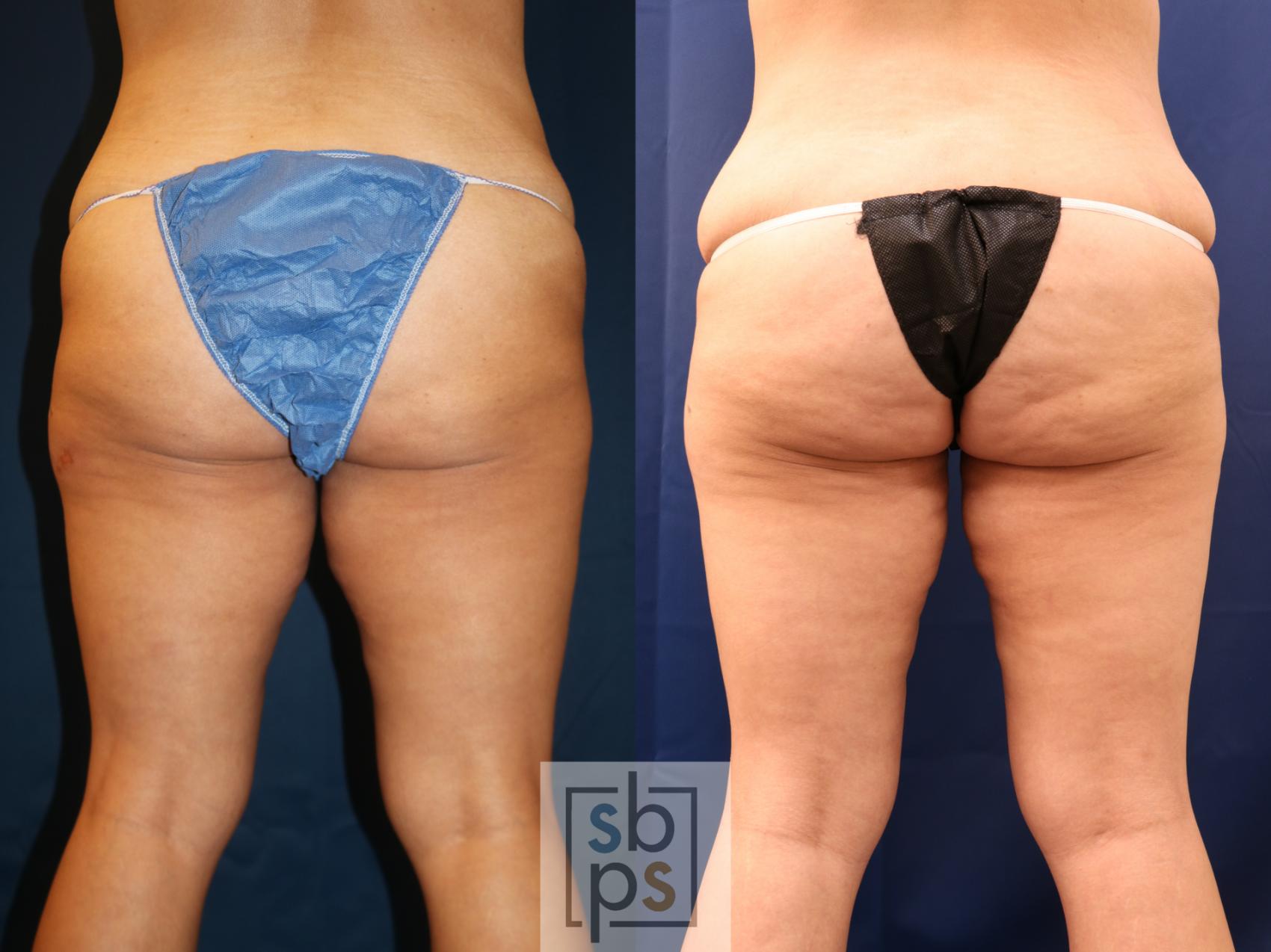 Before & After Liposuction Case 715 Back View in Torrance & Los Angeles, CA, CA