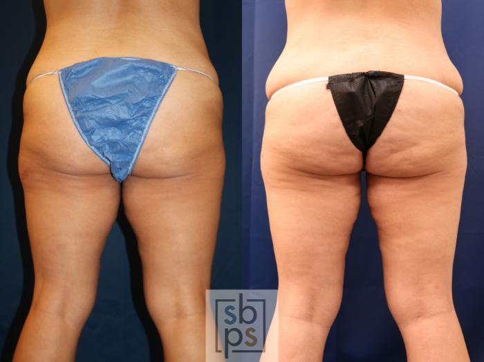 Before & After Liposuction Case 715 Back View in Los Angeles & Torrance, CA, CA