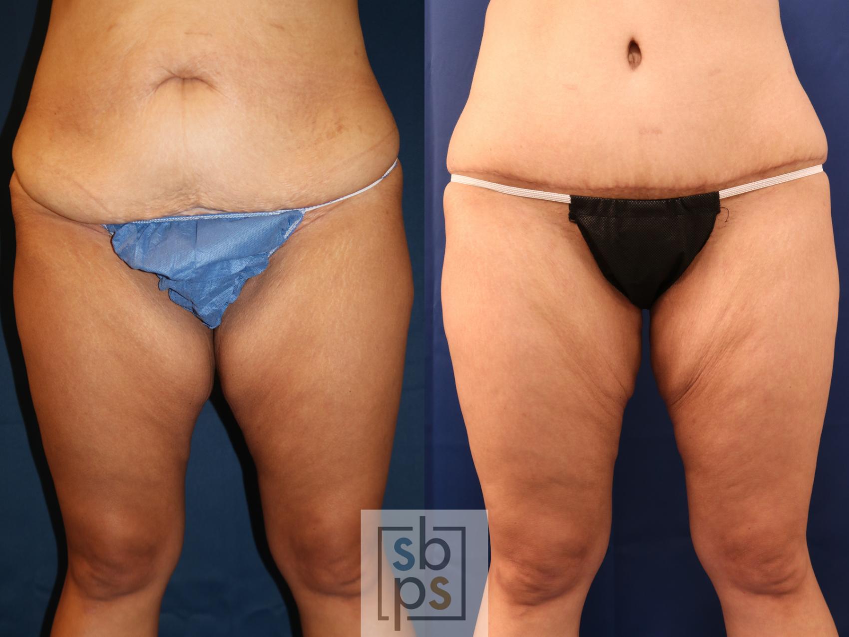 Before & After Liposuction Case 715 Front View in Los Angeles & Torrance, CA, CA