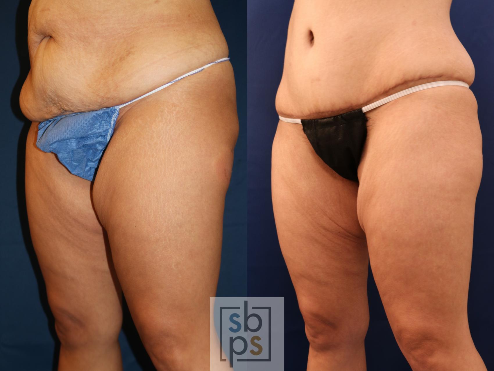 Before & After Liposuction Case 715 Left Oblique View in Torrance & Los Angeles, CA, CA