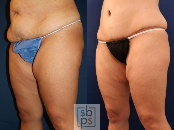 Before & After Liposuction Case 715 Left Oblique View in Los Angeles & Torrance, CA, CA