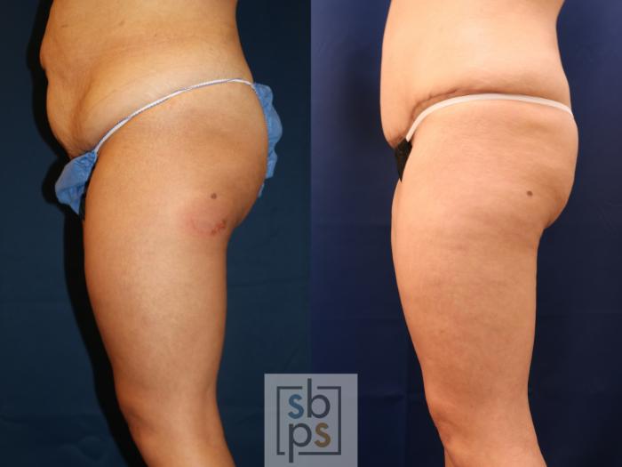 Before & After Liposuction Case 715 Left Side View in Los Angeles & Torrance, CA, CA