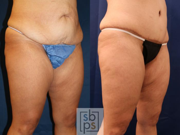 Before & After Liposuction Case 715 Right Oblique View in Los Angeles & Torrance, CA, CA