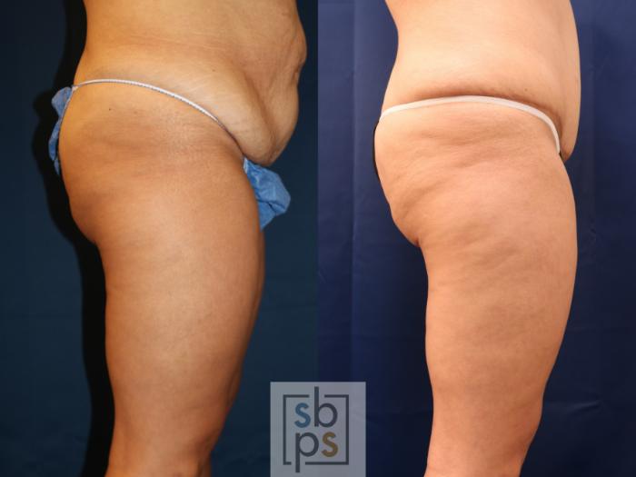 Before & After Liposuction Case 715 Right Side View in Los Angeles & Torrance, CA, CA