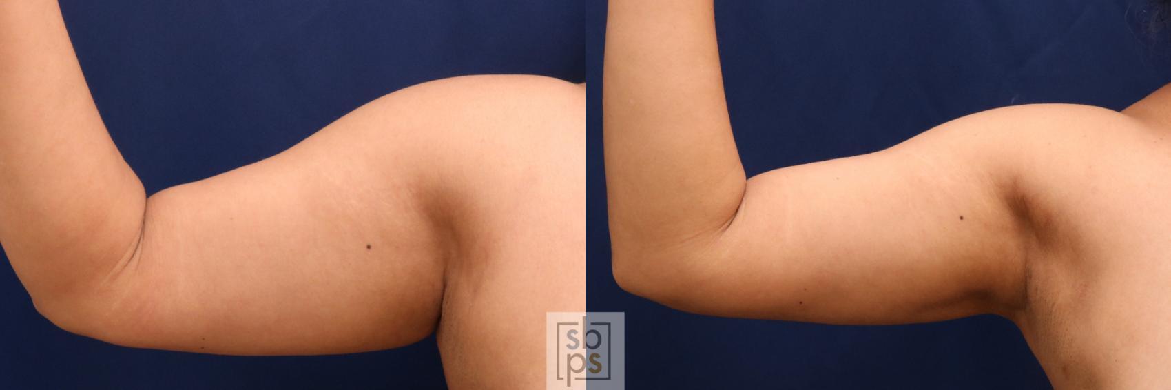 Before & After Liposuction Case 727 Front Left View in Torrance & Los Angeles, CA, CA