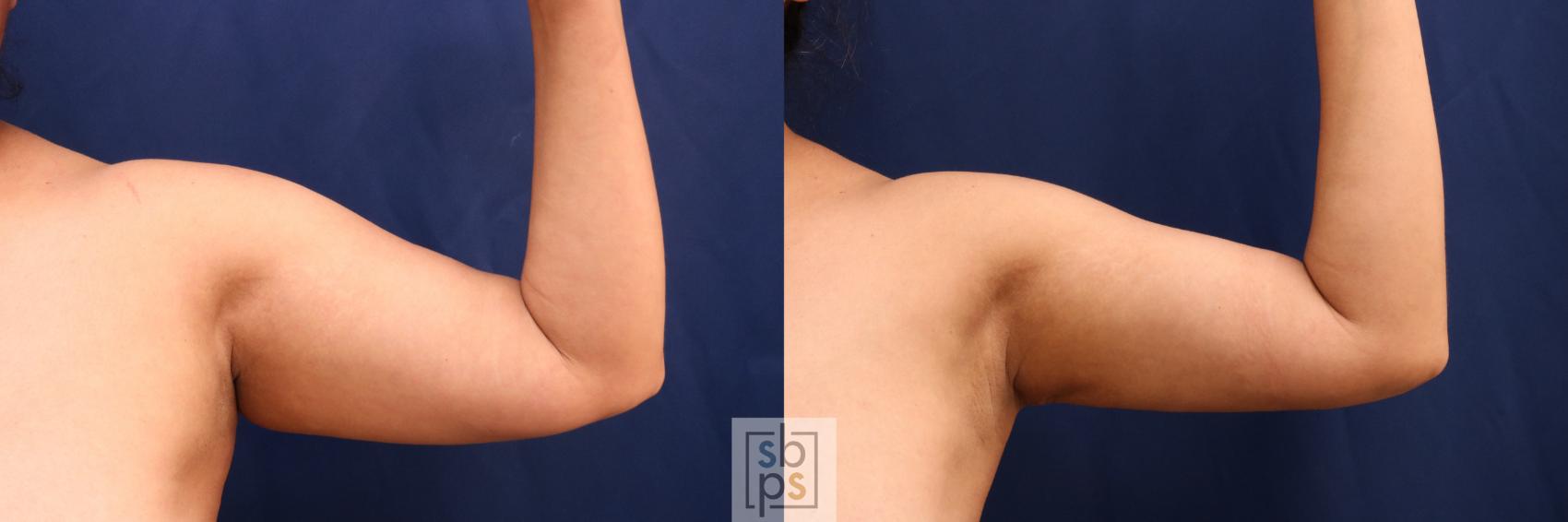 Before & After Liposuction Case 727 Front Right View in Torrance & Los Angeles, CA, CA