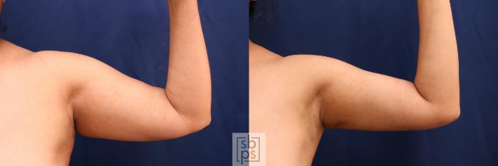 Before & After Liposuction Case 727 Front Right View in Los Angeles & Torrance, CA, CA