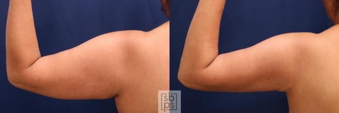 Before & After Liposuction Case 727 Left Side View in Los Angeles & Torrance, CA, CA