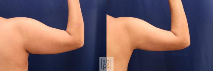 Before & After Liposuction Case 727 Right Side View in Los Angeles & Torrance, CA, CA