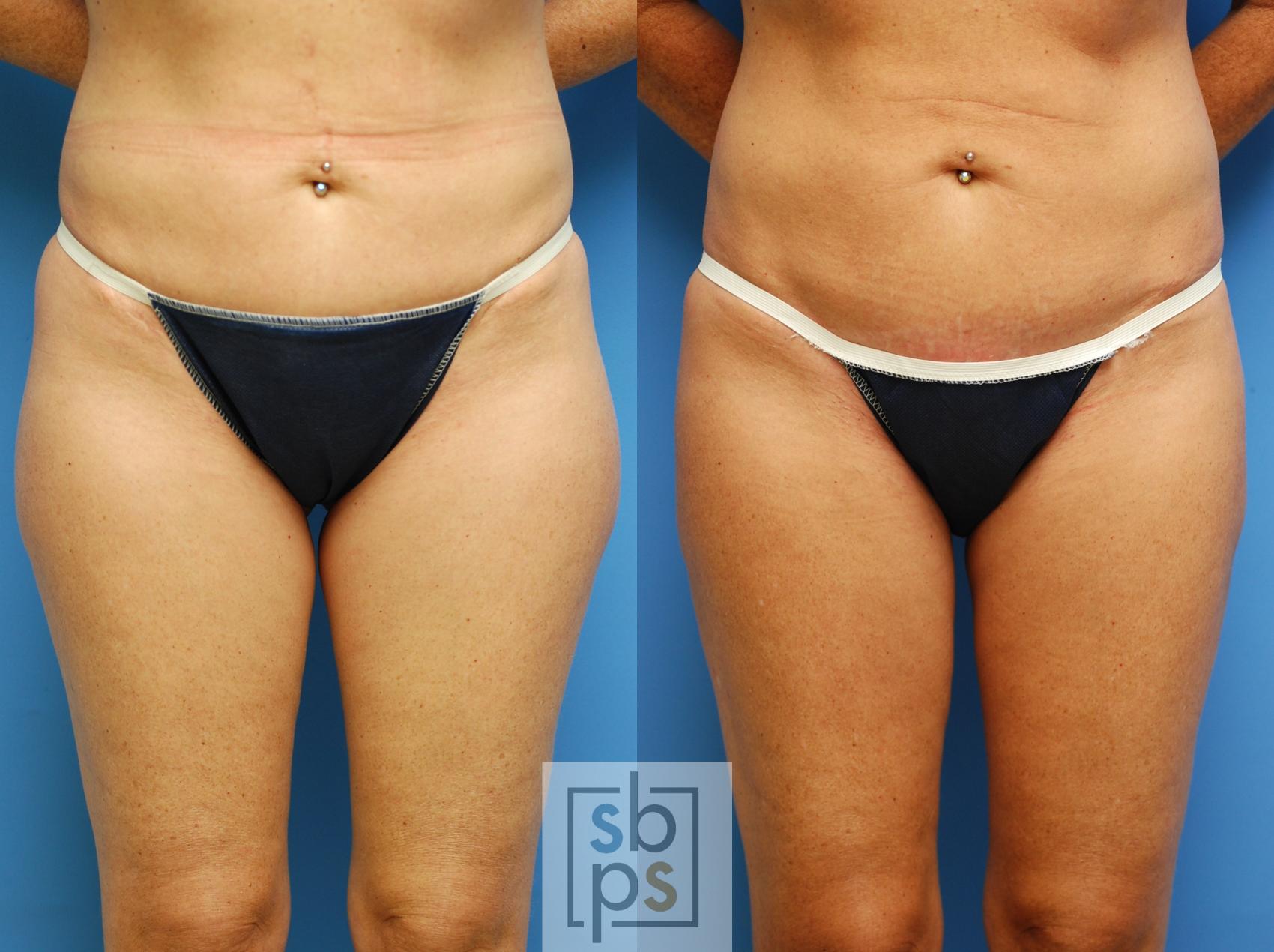 Before & After Liposuction Case 82 View #1 View in Torrance, CA