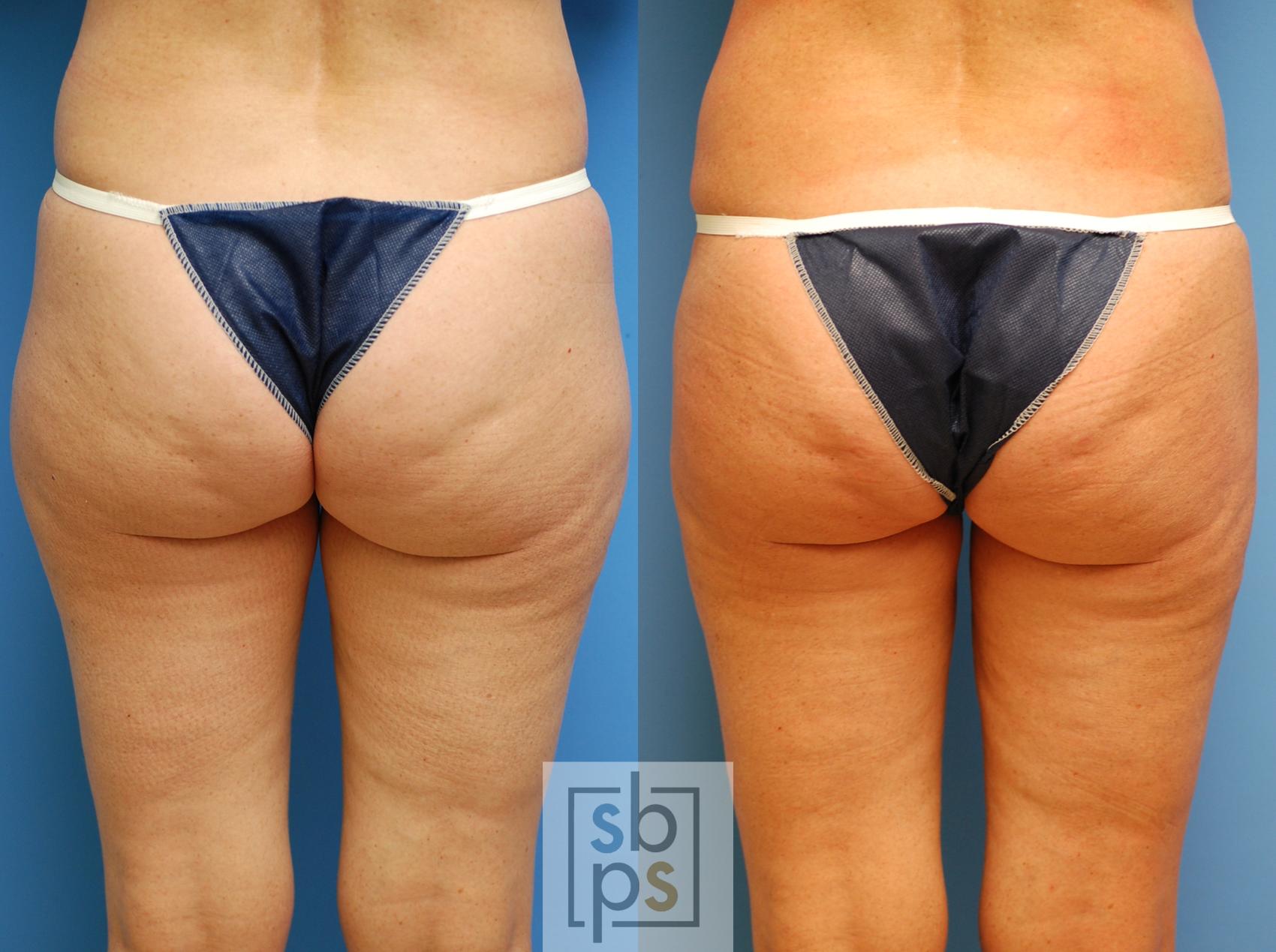 Before & After Liposuction Case 82 View #2 View in Torrance & Los Angeles, CA, CA