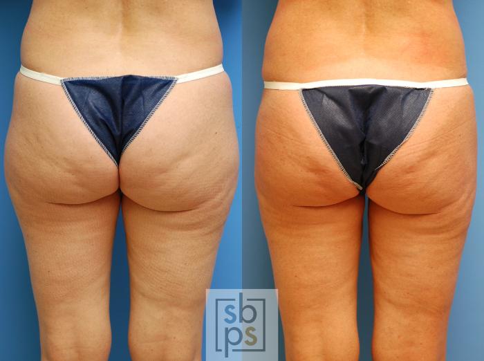 Before & After Liposuction Case 82 View #2 View in Torrance, CA