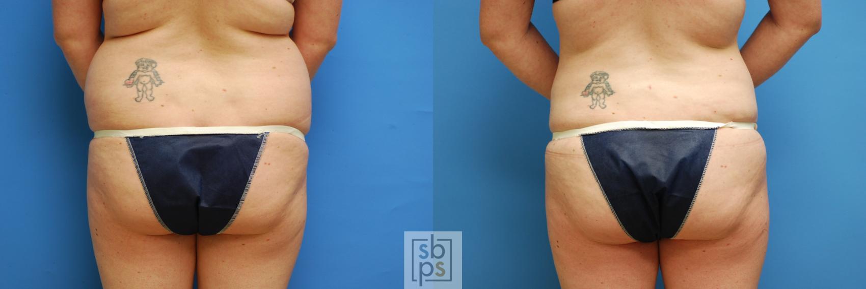 Before & After Liposuction Case 90 View #1 View in Torrance, CA