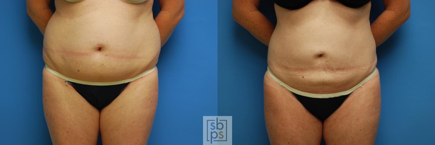 Before & After Liposuction Case 90 View #2 View in Torrance & Los Angeles, CA, CA