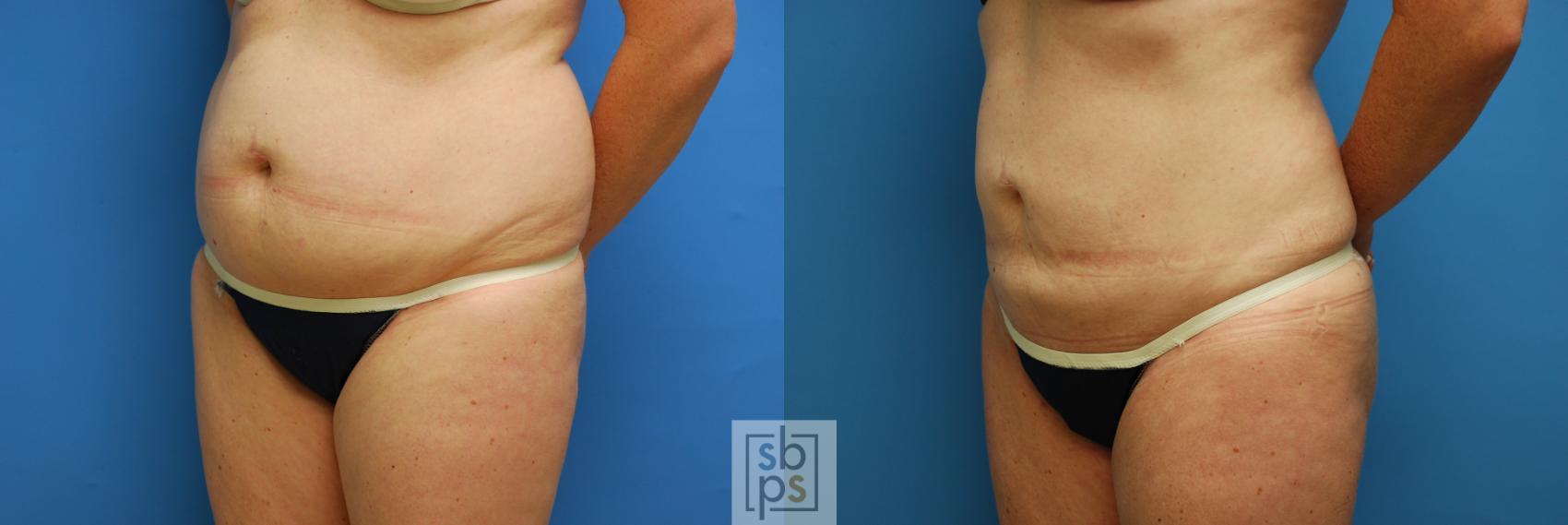 Before & After Liposuction Case 90 View #3 View in Torrance & Los Angeles, CA, CA