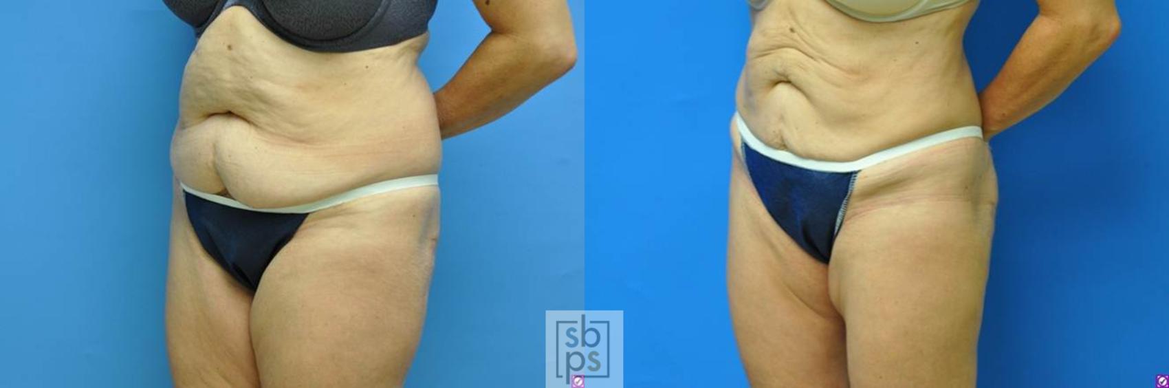 Before & After Liposuction Case 98 View #1 View in Torrance, CA