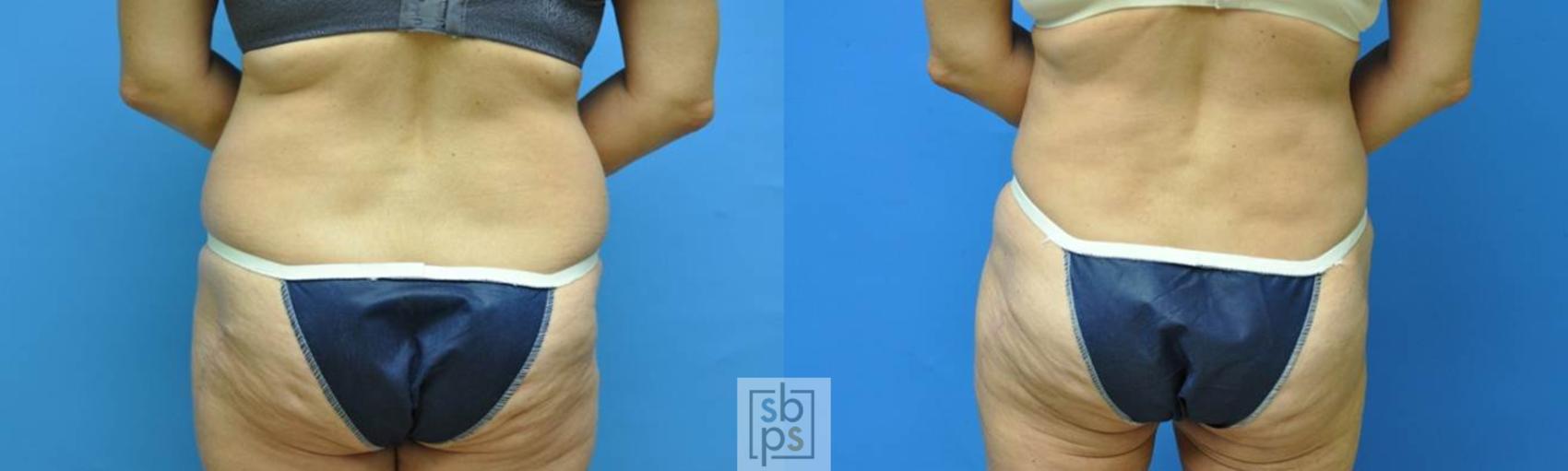 Before & After Liposuction Case 98 View #2 View in Torrance, CA
