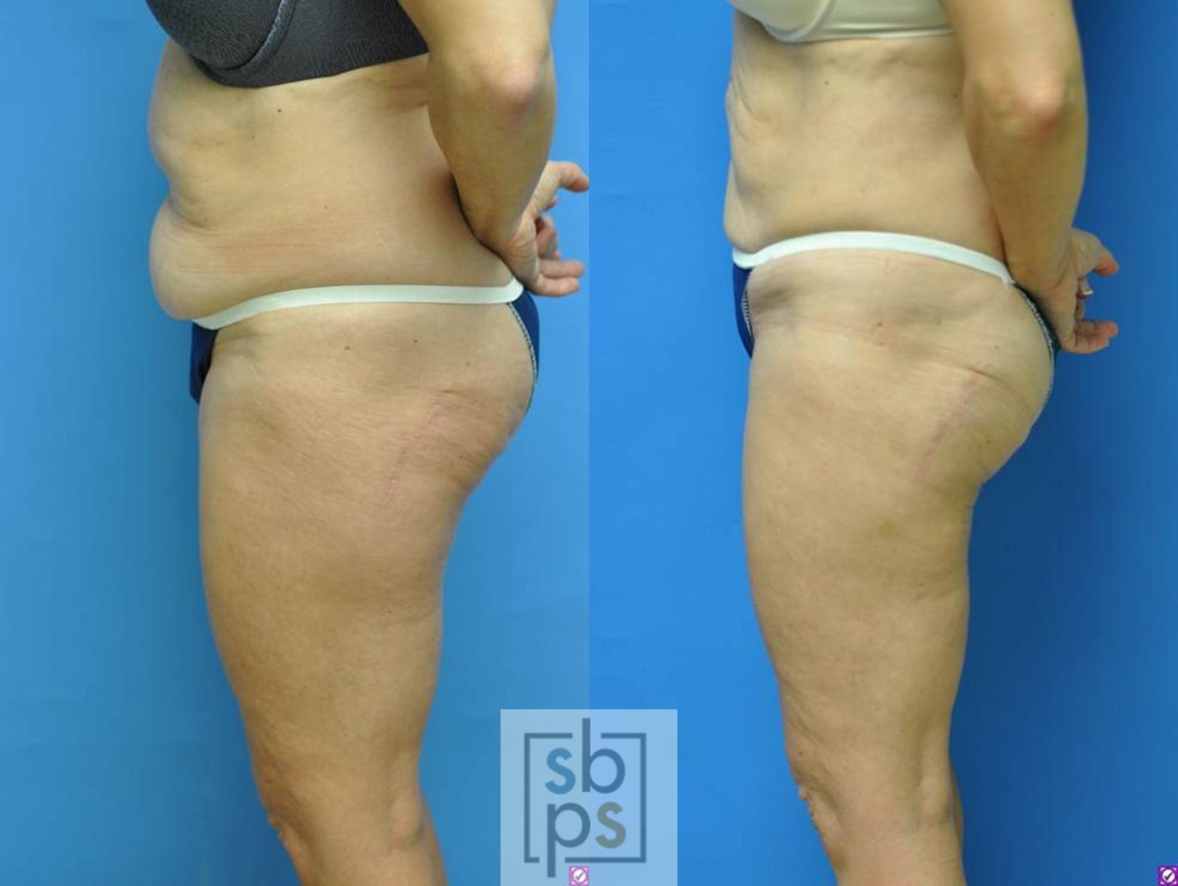Before & After Liposuction Case 98 View #3 View in Torrance, CA