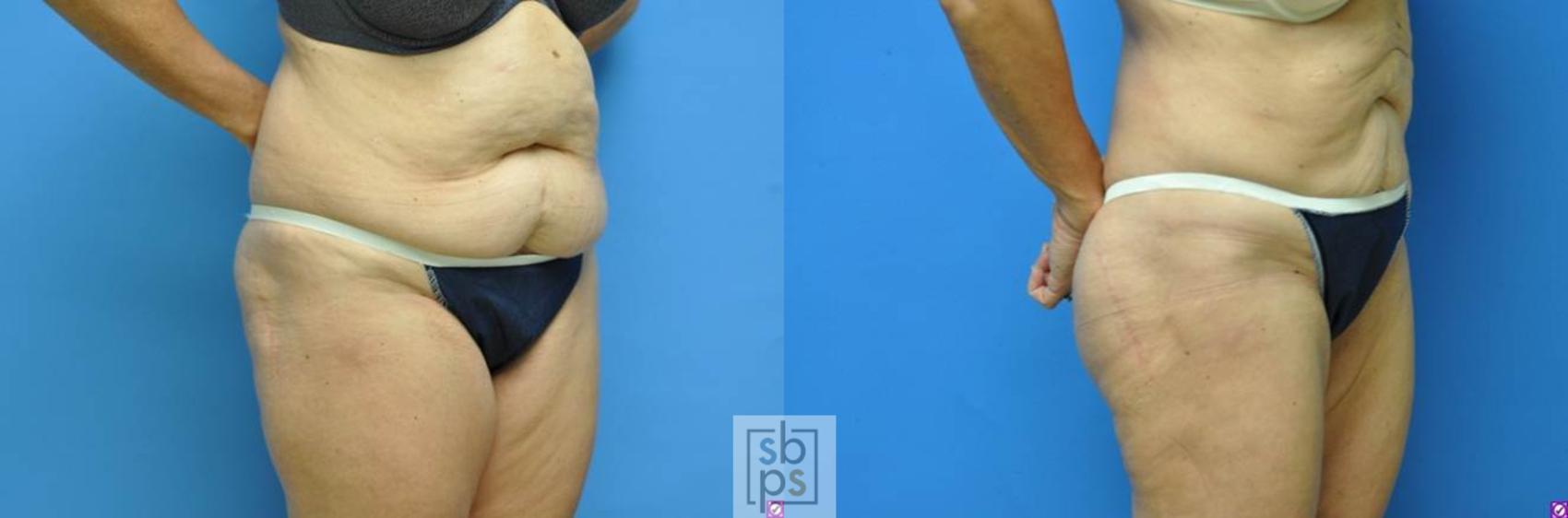 Before & After Liposuction Case 98 View #4 View in Los Angeles, Torrance & Long Beach, CA