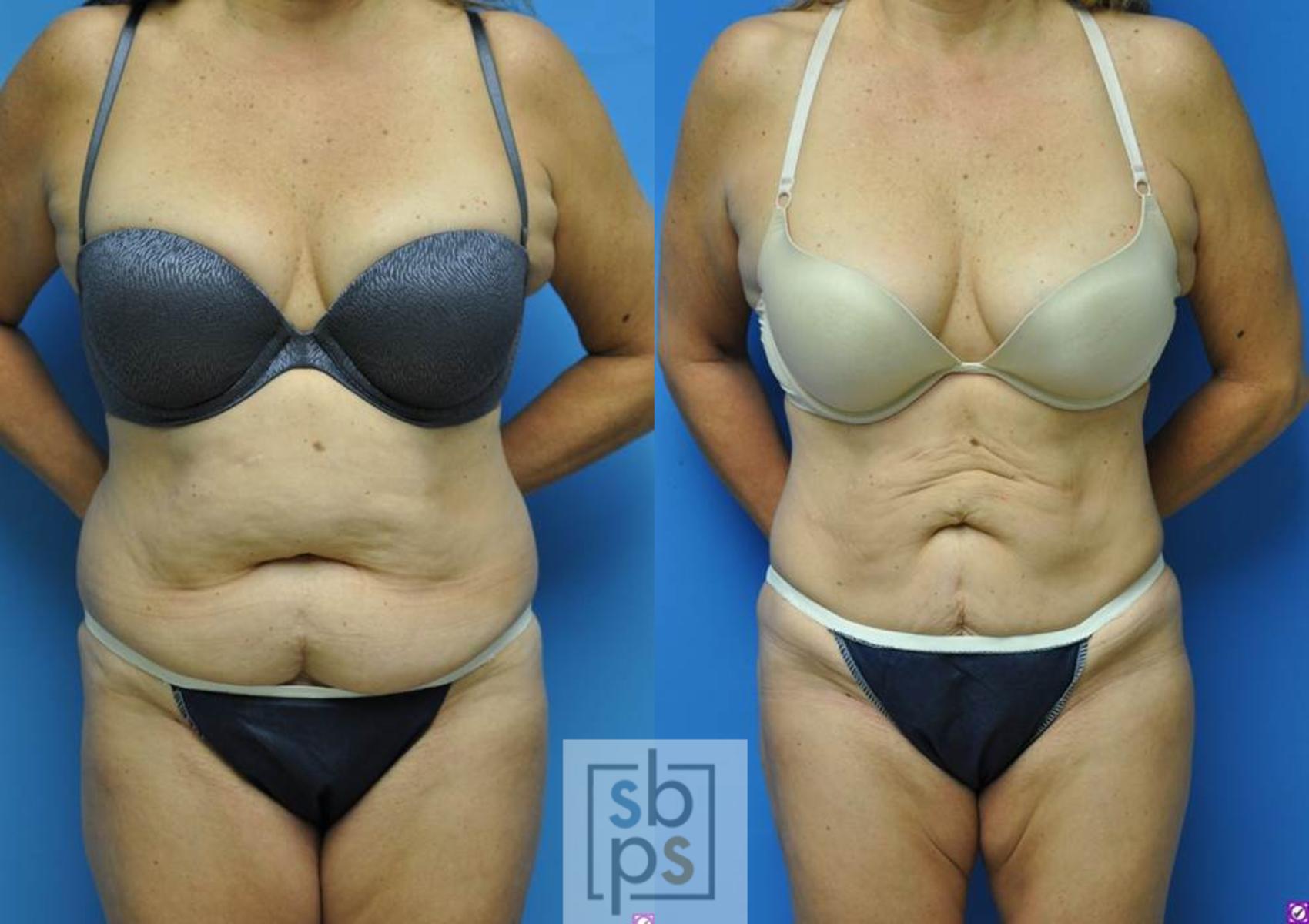 Before & After Liposuction Case 98 View #5 View in Torrance, CA