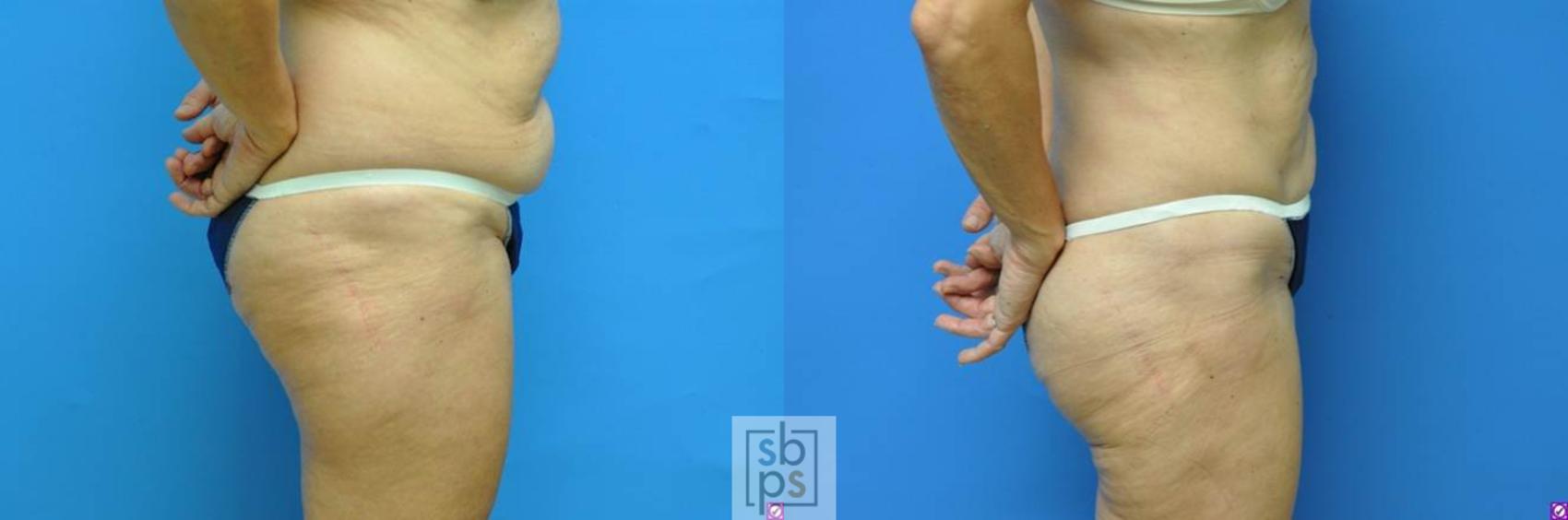 Before & After Liposuction Case 98 View #6 View in Torrance, CA