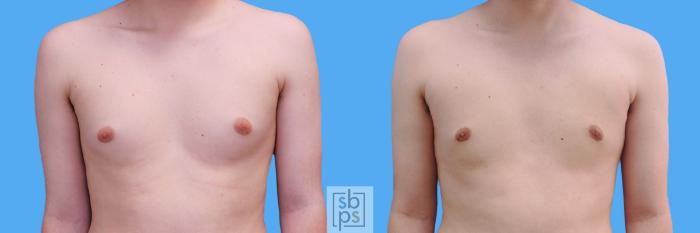 Before & After Male Breast Reduction Case 210 View #1 View in Torrance, CA