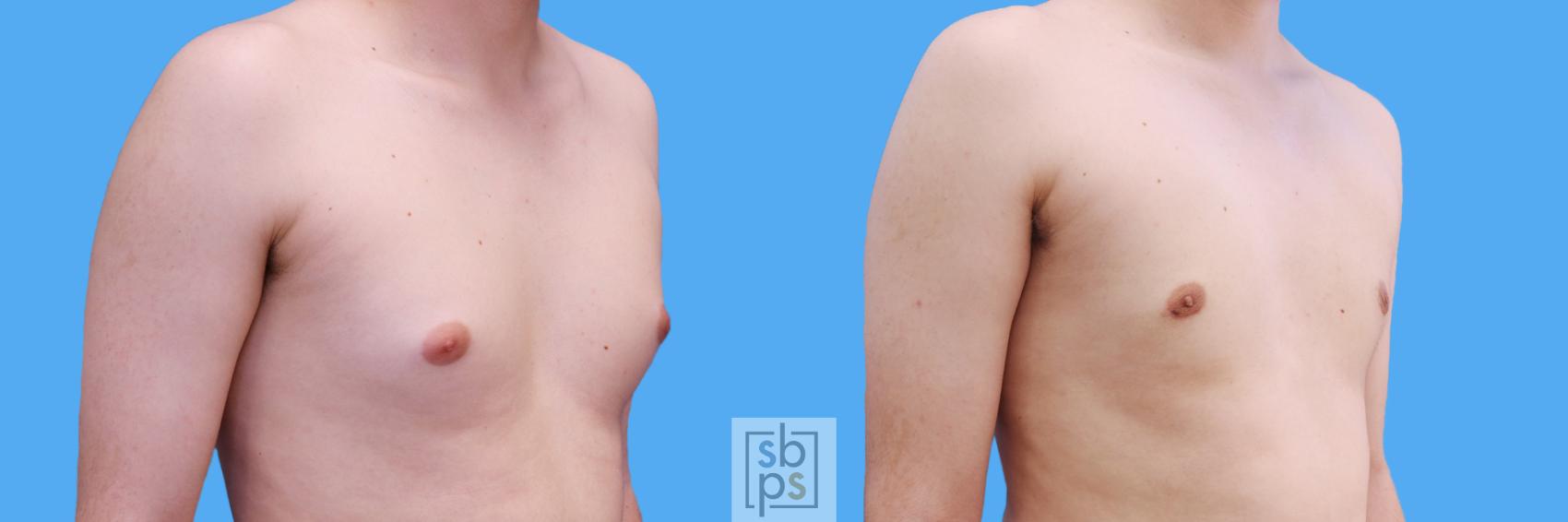 Before & After Male Breast Reduction Case 210 View #2 View in Torrance & Los Angeles, CA, CA