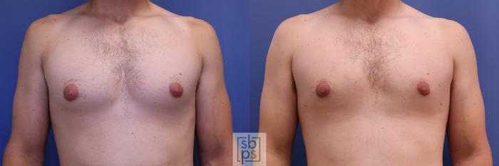 Before & After Male Breast Reduction Case 427 Front View in Torrance, CA