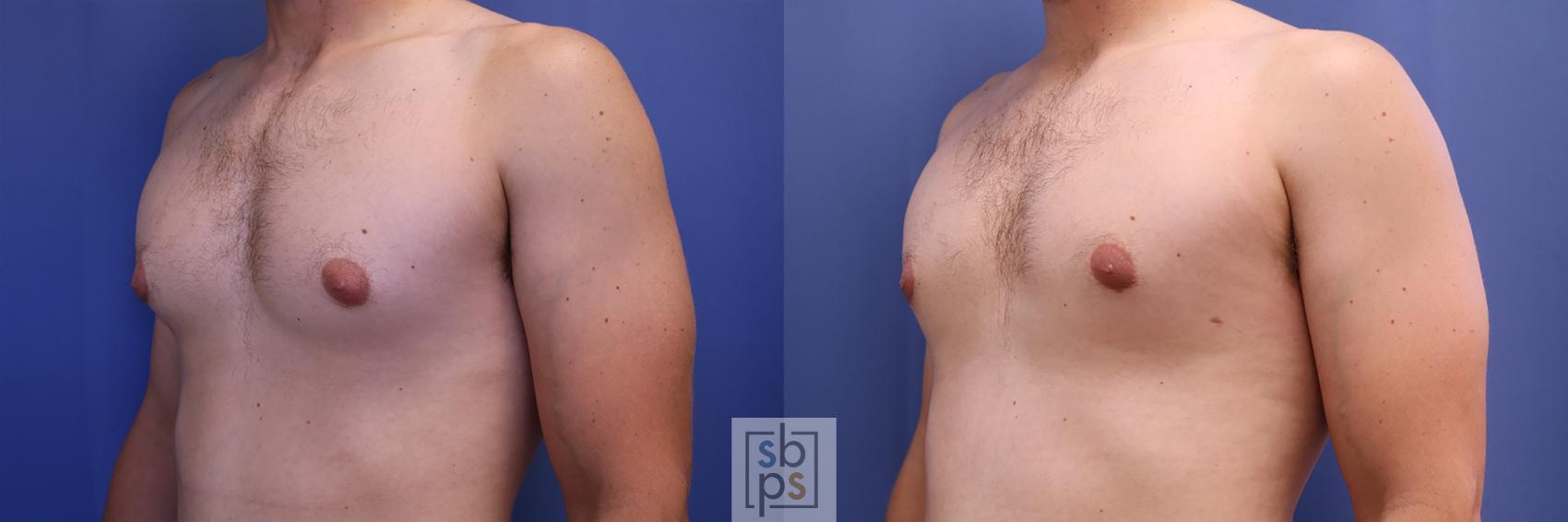 Before & After Male Breast Reduction Case 427 Left Oblique View in Torrance, CA