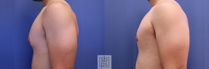 Before & After Male Breast Reduction Case 427 Left Side View in Torrance, CA