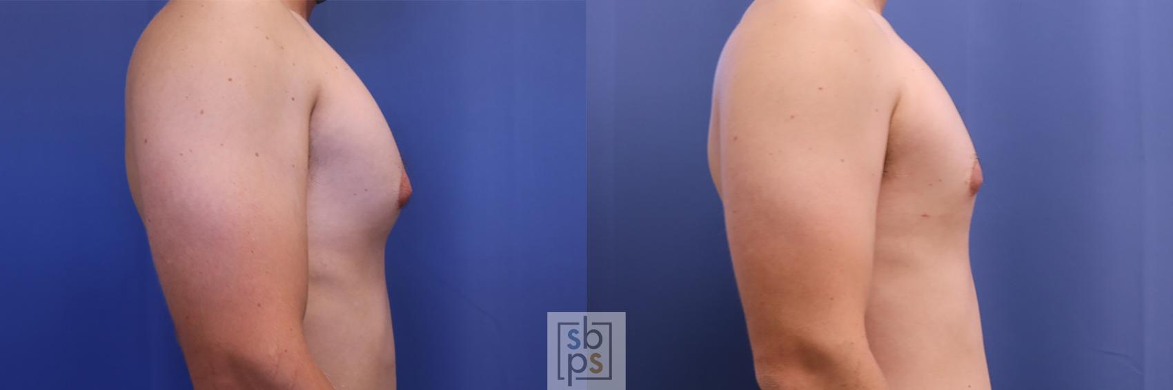 Before & After Male Breast Reduction Case 427 Right Side View in Torrance, CA