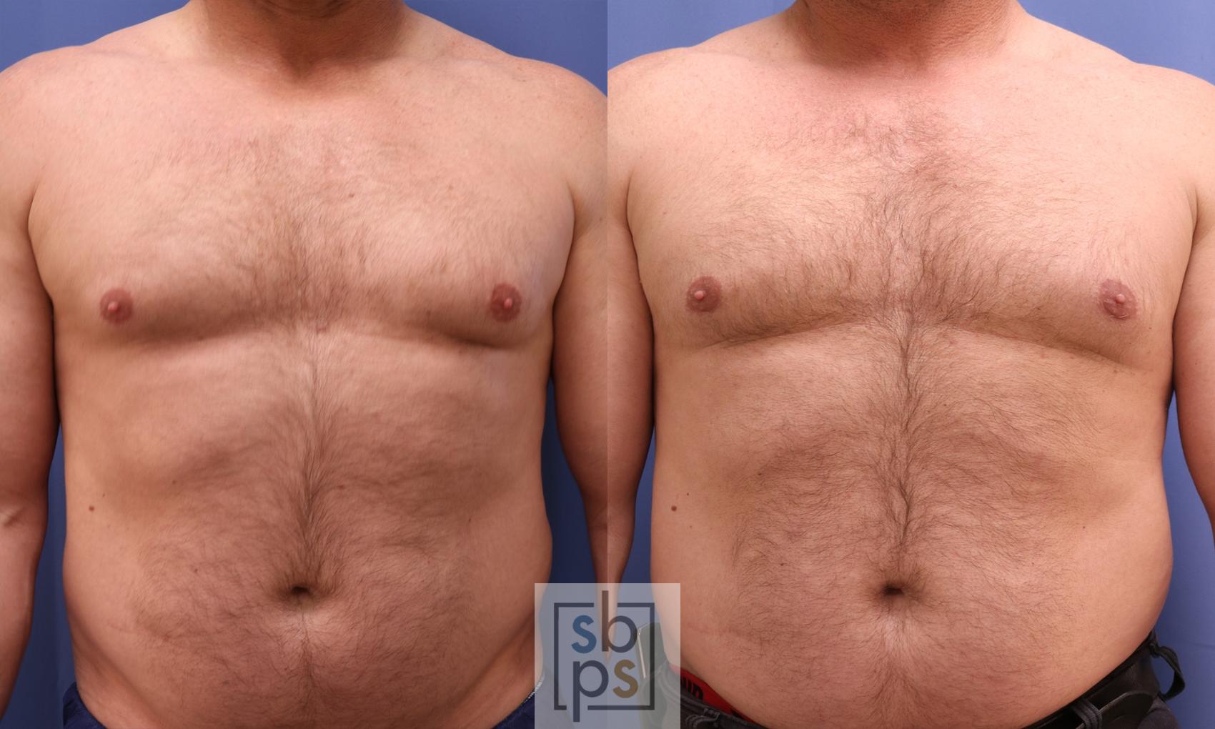 Before & After Male Breast Reduction Case 453 Front View in Torrance, CA