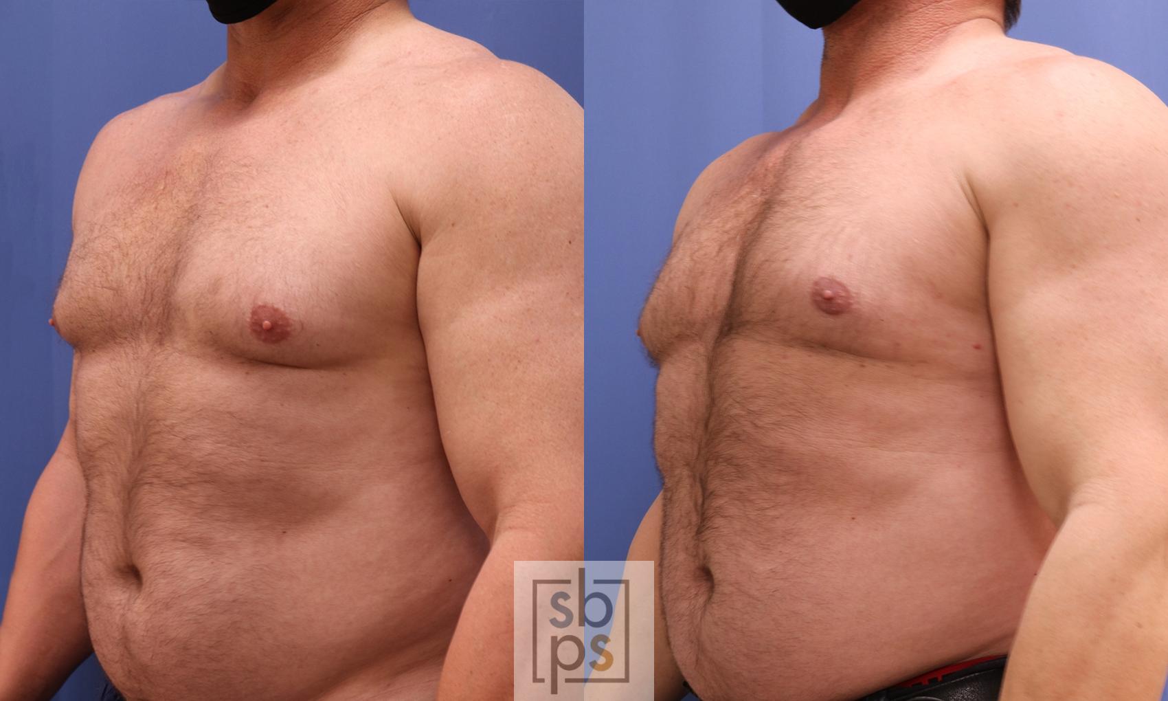 Before & After Male Breast Reduction Case 453 Left Oblique View in Torrance, CA