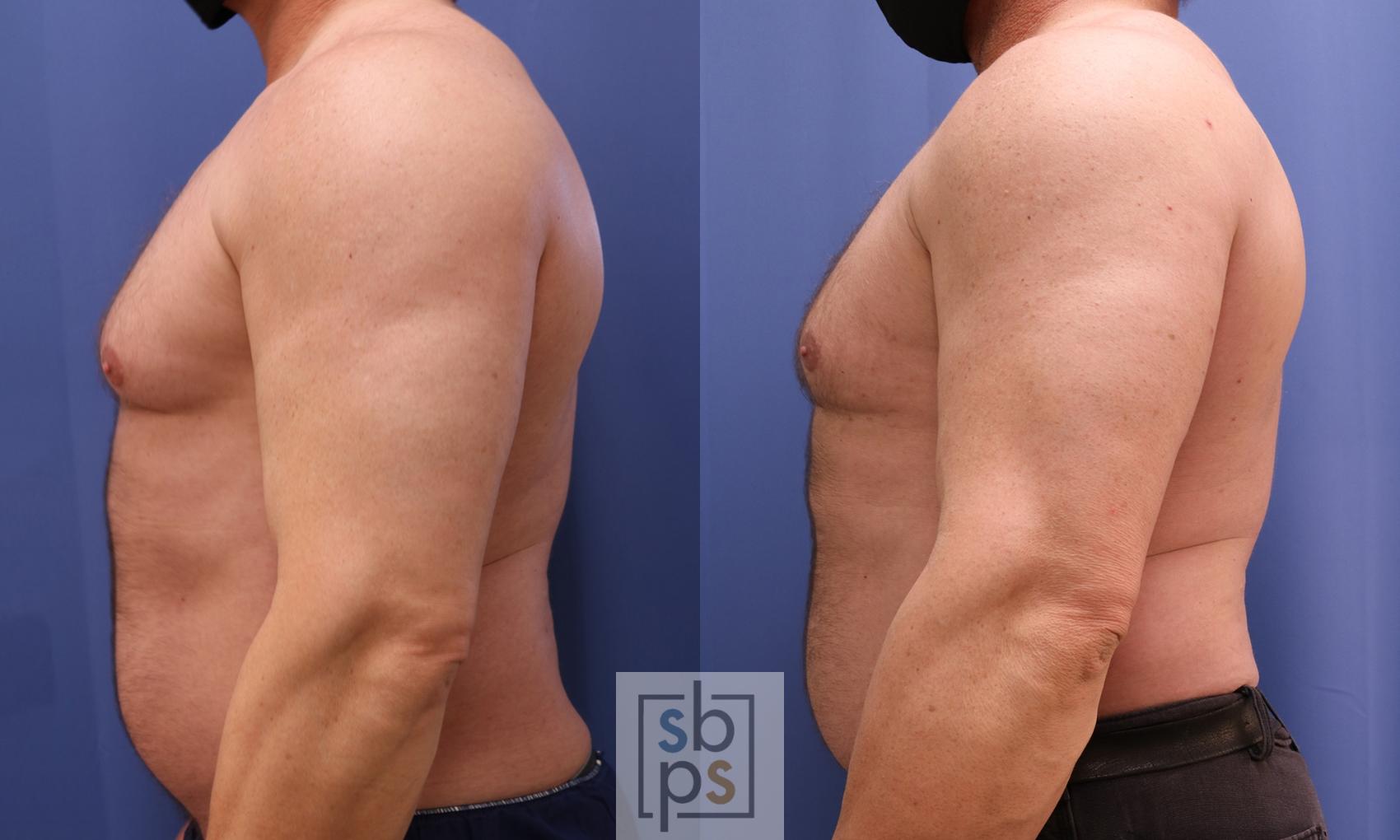 Before & After Male Breast Reduction Case 453 Left Side View in Torrance, CA